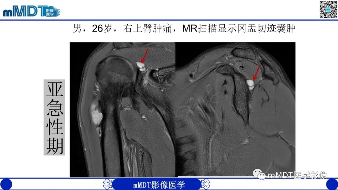 影像PPT - 【PPT】冈盂切迹囊肿继发肩胛上神经卡压-16