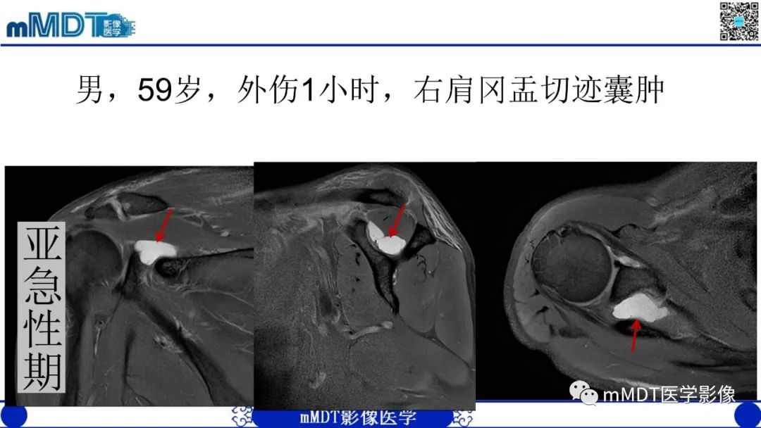 影像PPT - 【PPT】冈盂切迹囊肿继发肩胛上神经卡压-17