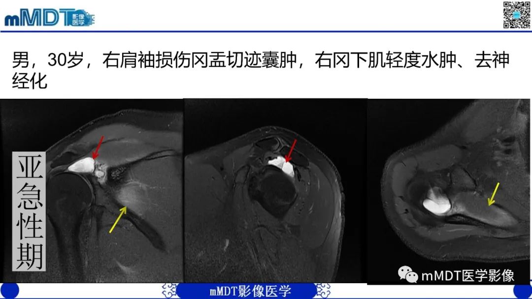 影像PPT - 【PPT】冈盂切迹囊肿继发肩胛上神经卡压-18