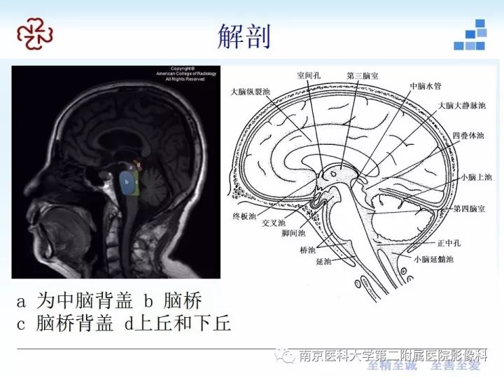 影像PPT - 【PPT】进行性核上性麻痹在MRI上的征象分析-4