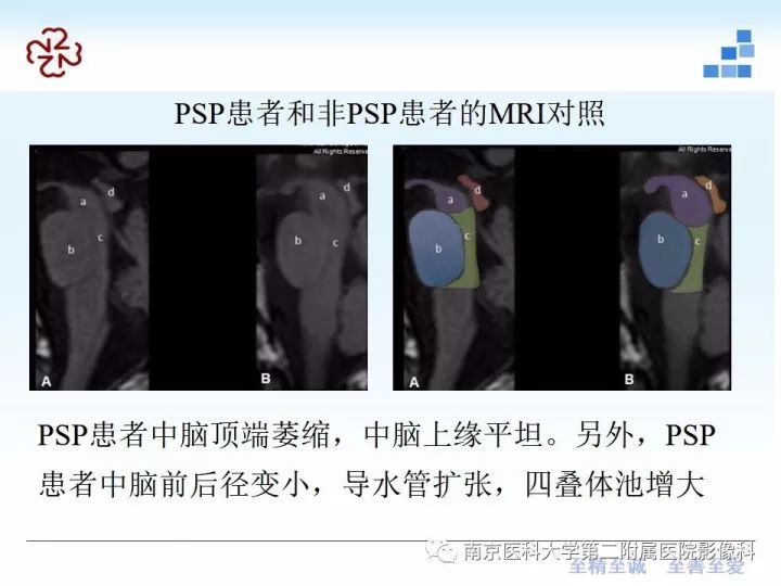 影像PPT - 【PPT】进行性核上性麻痹在MRI上的征象分析-10