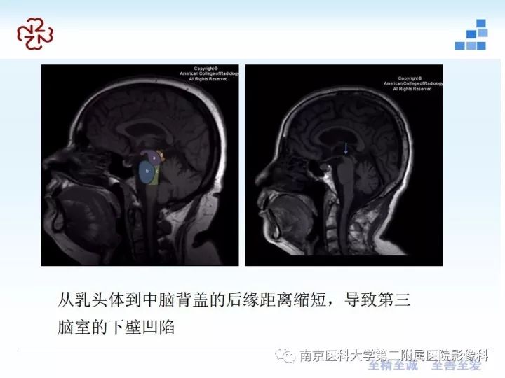 影像PPT - 【PPT】进行性核上性麻痹在MRI上的征象分析-7