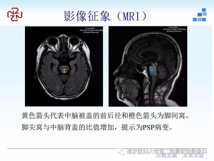 影像PPT - 【PPT】进行性核上性麻痹在MRI上的征象分析-6