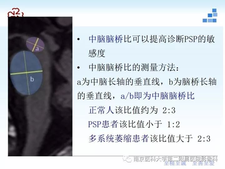 影像PPT - 【PPT】进行性核上性麻痹在MRI上的征象分析-9