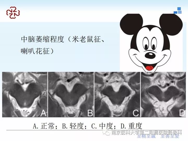 影像PPT - 【PPT】进行性核上性麻痹在MRI上的征象分析-11