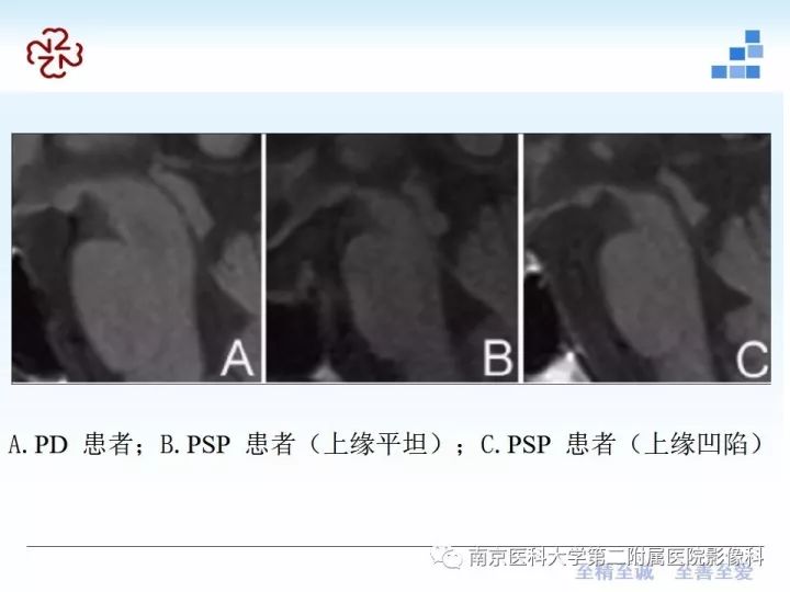 影像PPT - 【PPT】进行性核上性麻痹在MRI上的征象分析-17