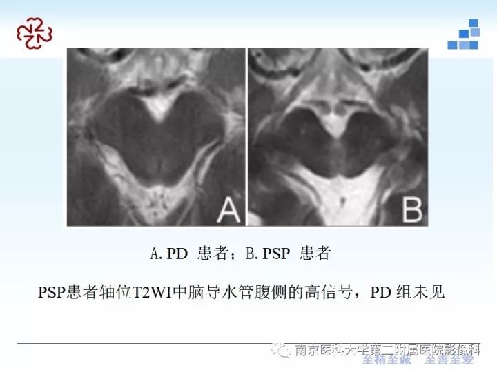 影像PPT - 【PPT】进行性核上性麻痹在MRI上的征象分析-18