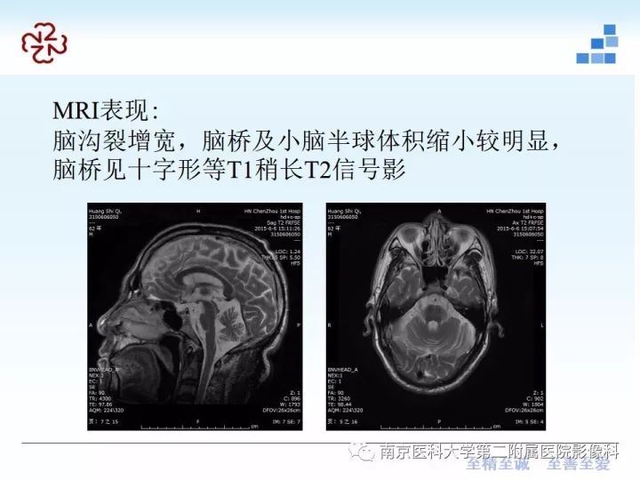 影像PPT - 【PPT】进行性核上性麻痹在MRI上的征象分析-20