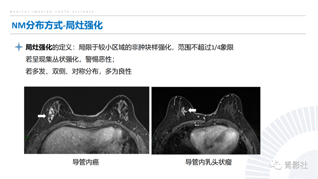 影像PPT - 【PPT】乳腺非肿块样强化病变的影像诊断思路-5