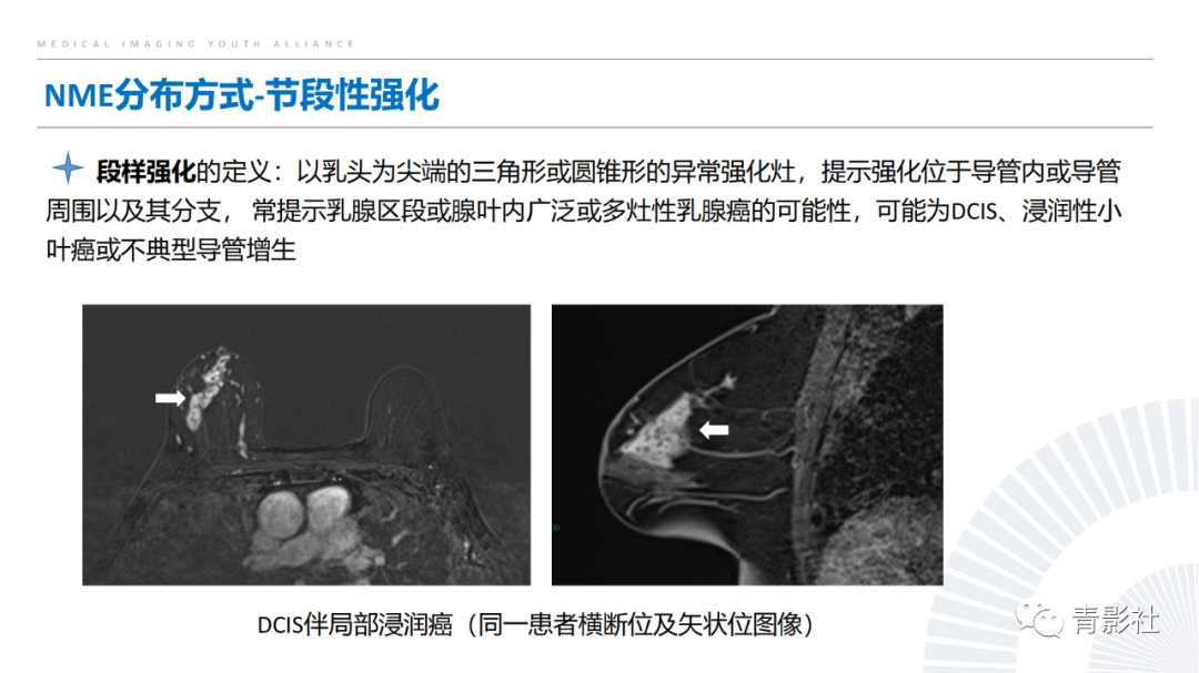 影像PPT - 【PPT】乳腺非肿块样强化病变的影像诊断思路-7