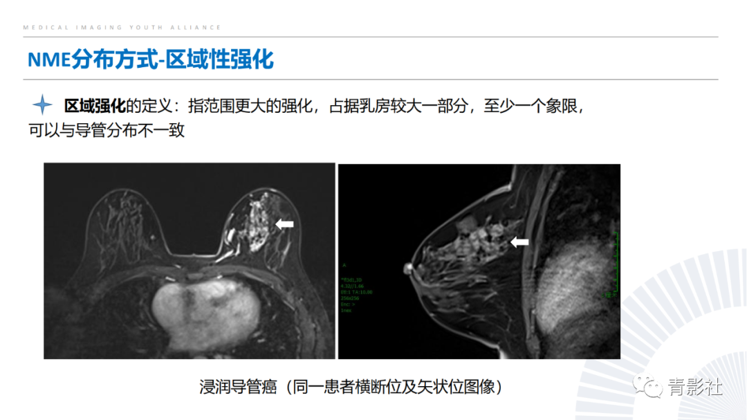影像PPT - 【PPT】乳腺非肿块样强化病变的影像诊断思路-8