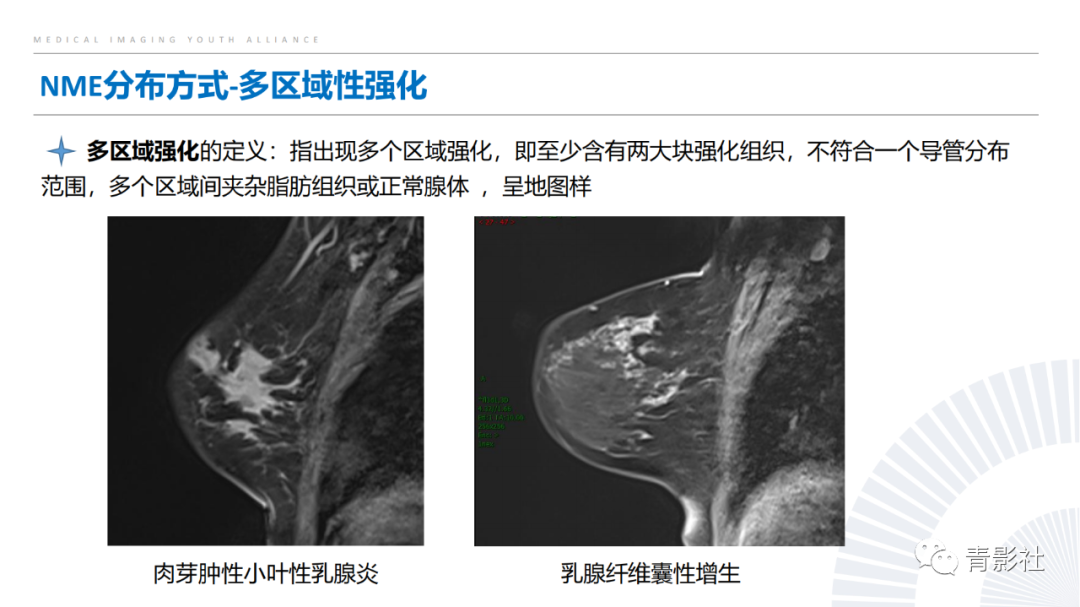 影像PPT - 【PPT】乳腺非肿块样强化病变的影像诊断思路-9