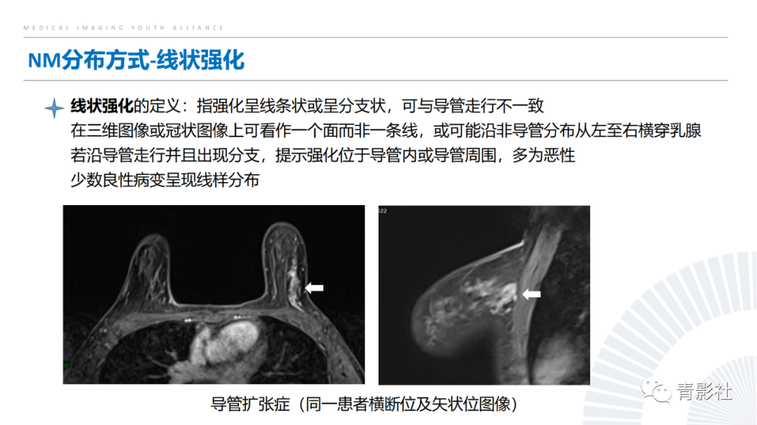 影像PPT - 【PPT】乳腺非肿块样强化病变的影像诊断思路-6