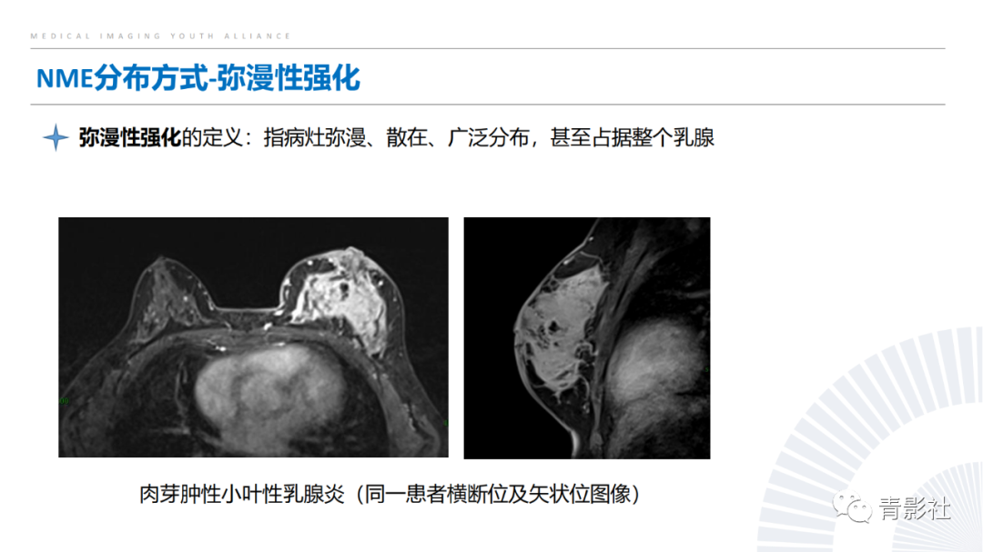 影像PPT - 【PPT】乳腺非肿块样强化病变的影像诊断思路-10