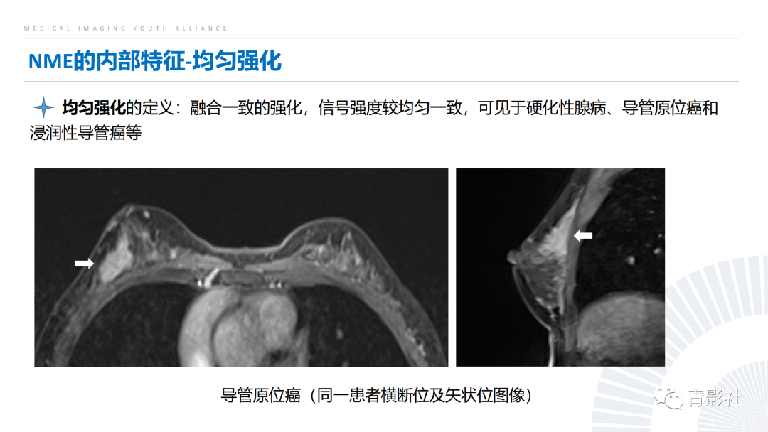 影像PPT - 【PPT】乳腺非肿块样强化病变的影像诊断思路-11