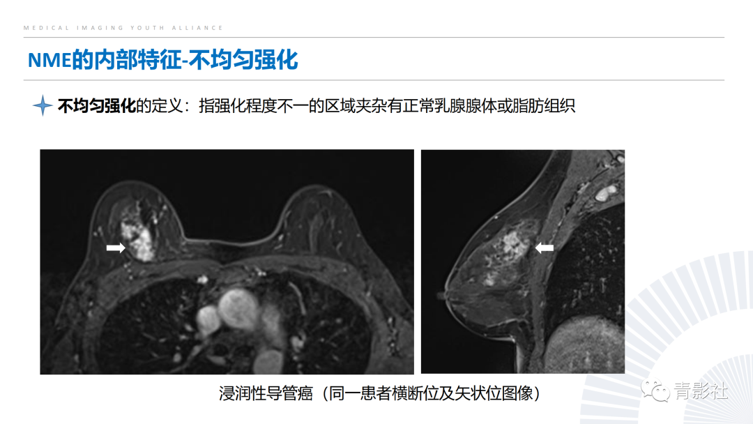 影像PPT - 【PPT】乳腺非肿块样强化病变的影像诊断思路-12