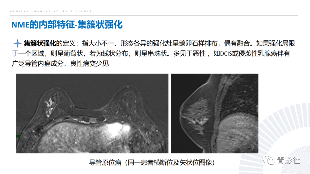 影像PPT - 【PPT】乳腺非肿块样强化病变的影像诊断思路-13