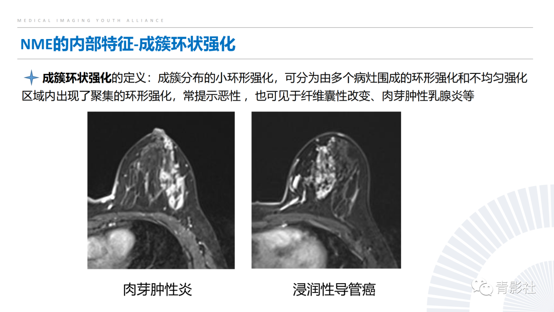影像PPT - 【PPT】乳腺非肿块样强化病变的影像诊断思路-14