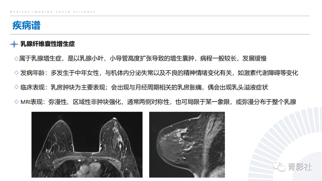 影像PPT - 【PPT】乳腺非肿块样强化病变的影像诊断思路-18
