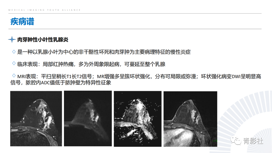 影像PPT - 【PPT】乳腺非肿块样强化病变的影像诊断思路-20
