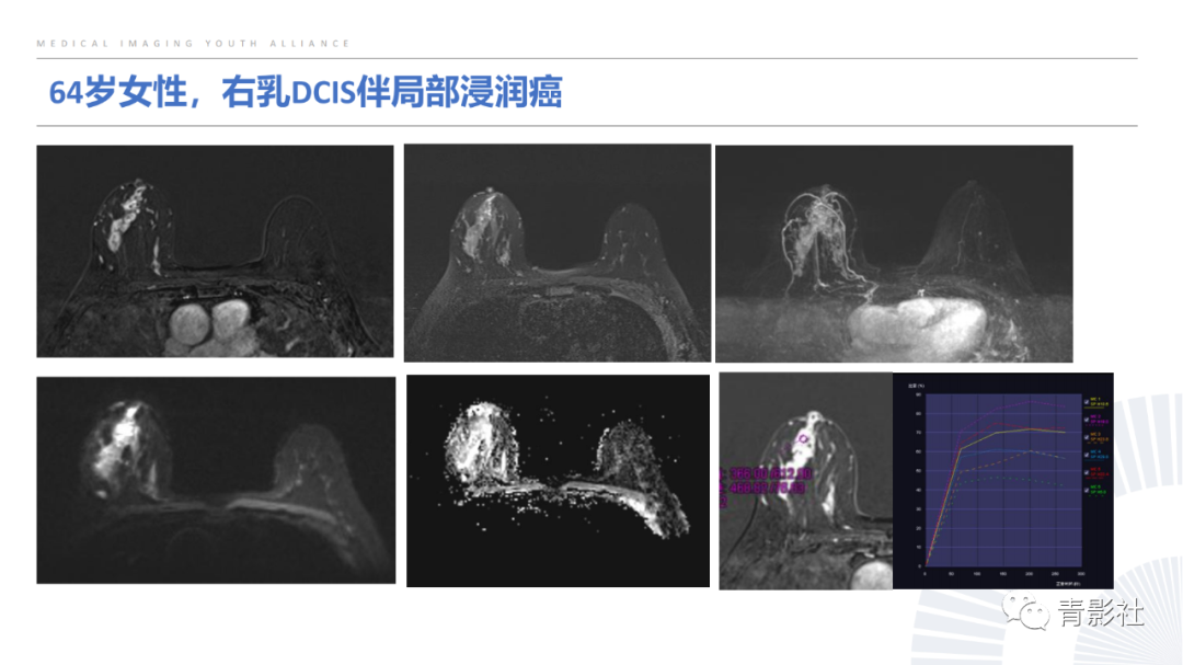 影像PPT - 【PPT】乳腺非肿块样强化病变的影像诊断思路-22