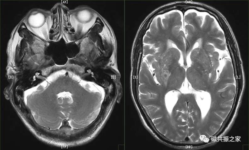 影像PPT - 几分钟就扫完的头颅MRI+MRA,是你想要的吗?-3 影像PPT - 几分钟就扫完的头颅MRI+MRA,是你想要的吗?-3