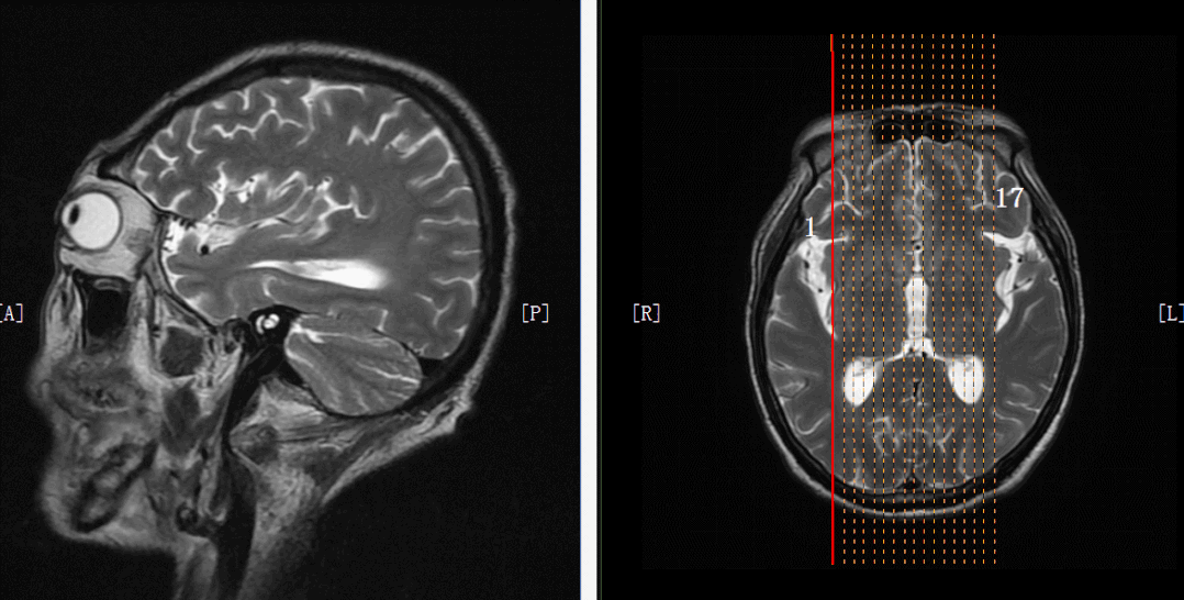 影像PPT - 几分钟就扫完的头颅MRI+MRA,是你想要的吗?-4 影像PPT - 几分钟就扫完的头颅MRI+MRA,是你想要的吗?-4