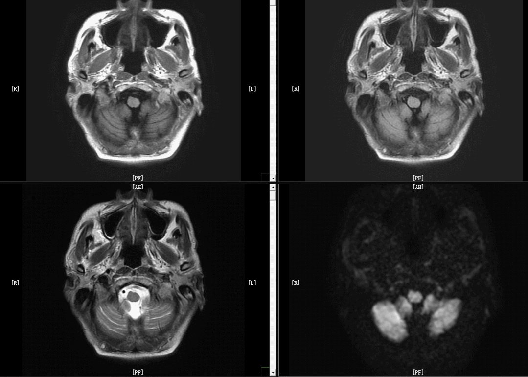 影像PPT - 几分钟就扫完的头颅MRI+MRA,是你想要的吗?-2 影像PPT - 几分钟就扫完的头颅MRI+MRA,是你想要的吗?-2