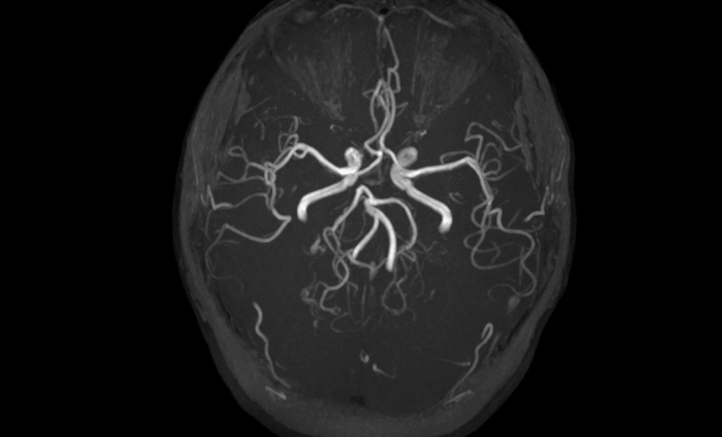 影像PPT - 几分钟就扫完的头颅MRI+MRA,是你想要的吗?-5 影像PPT - 几分钟就扫完的头颅MRI+MRA,是你想要的吗?-5
