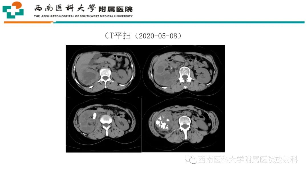 影像PPT - 【PPT】黄色肉芽肿性肾盂肾炎-4