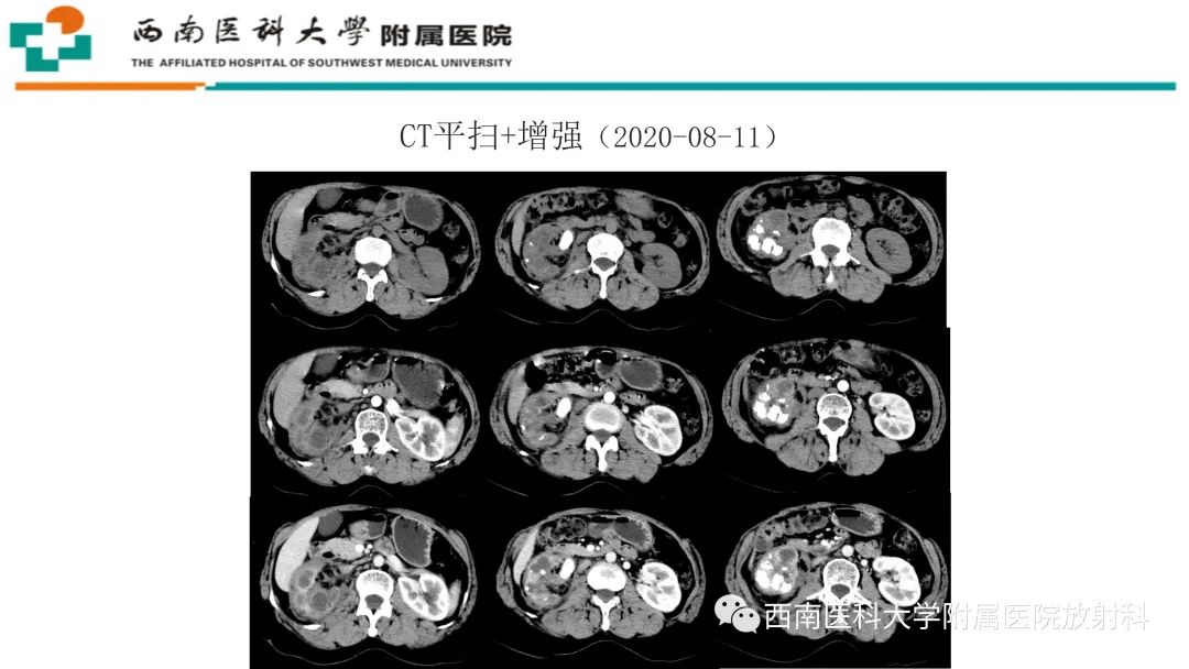 影像PPT - 【PPT】黄色肉芽肿性肾盂肾炎-5