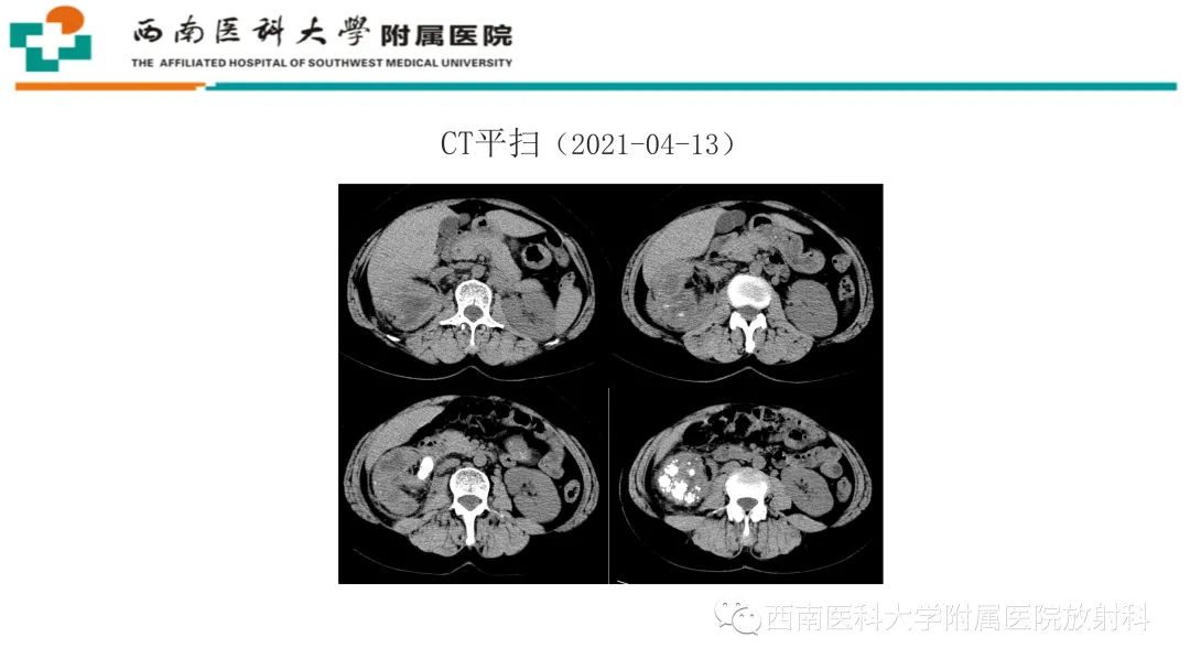 影像PPT - 【PPT】黄色肉芽肿性肾盂肾炎-6