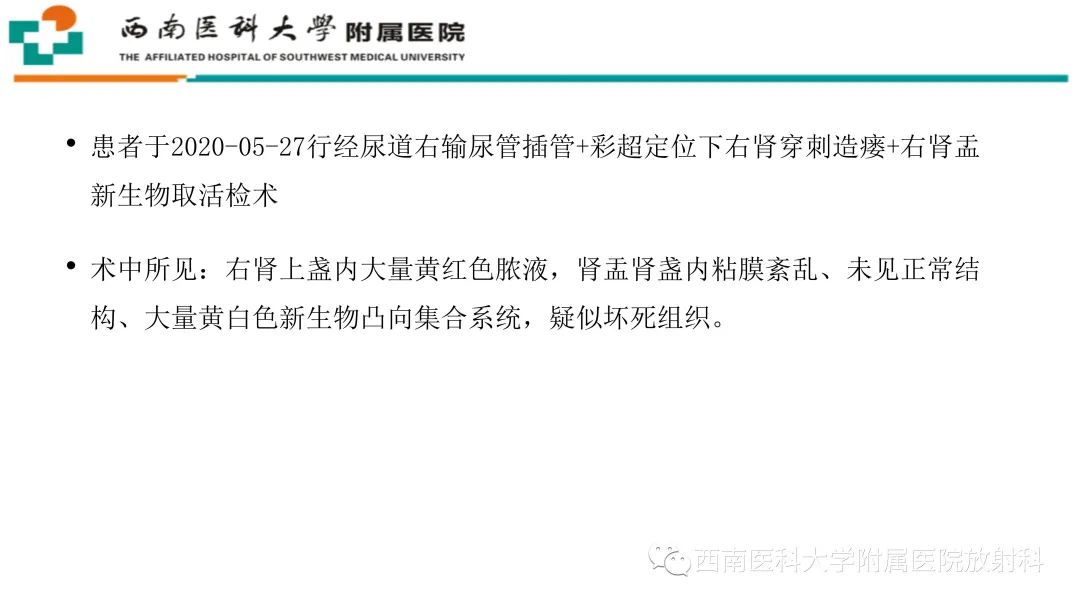 影像PPT - 【PPT】黄色肉芽肿性肾盂肾炎-8