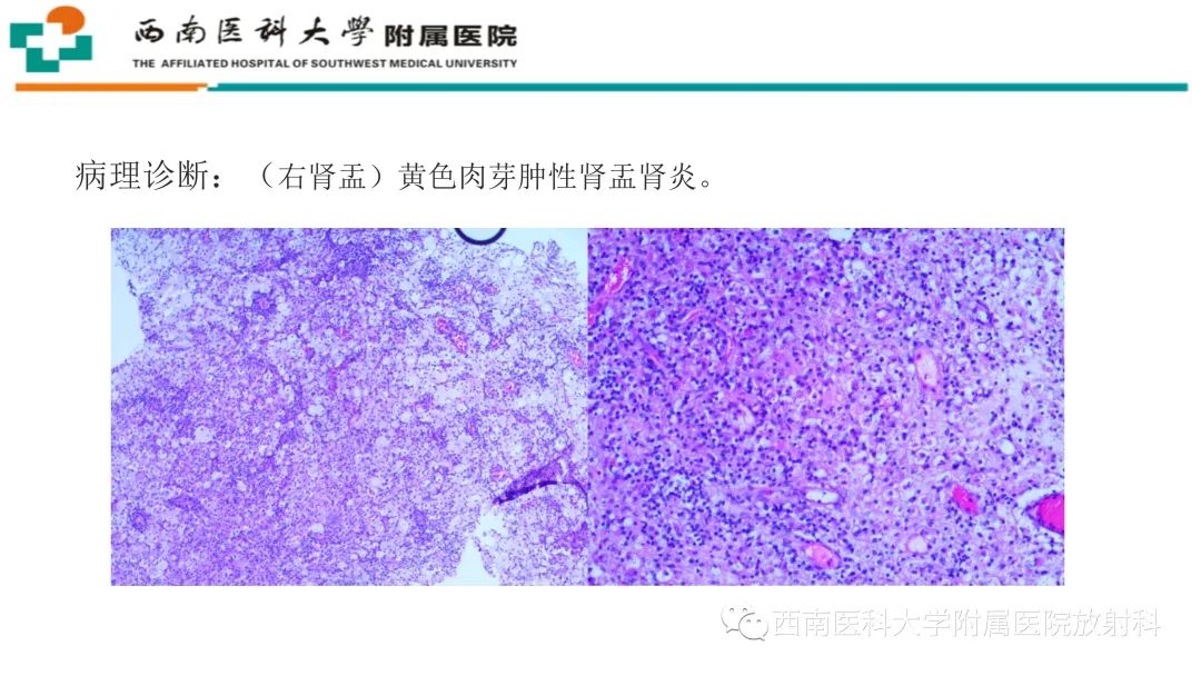 影像PPT - 【PPT】黄色肉芽肿性肾盂肾炎-9