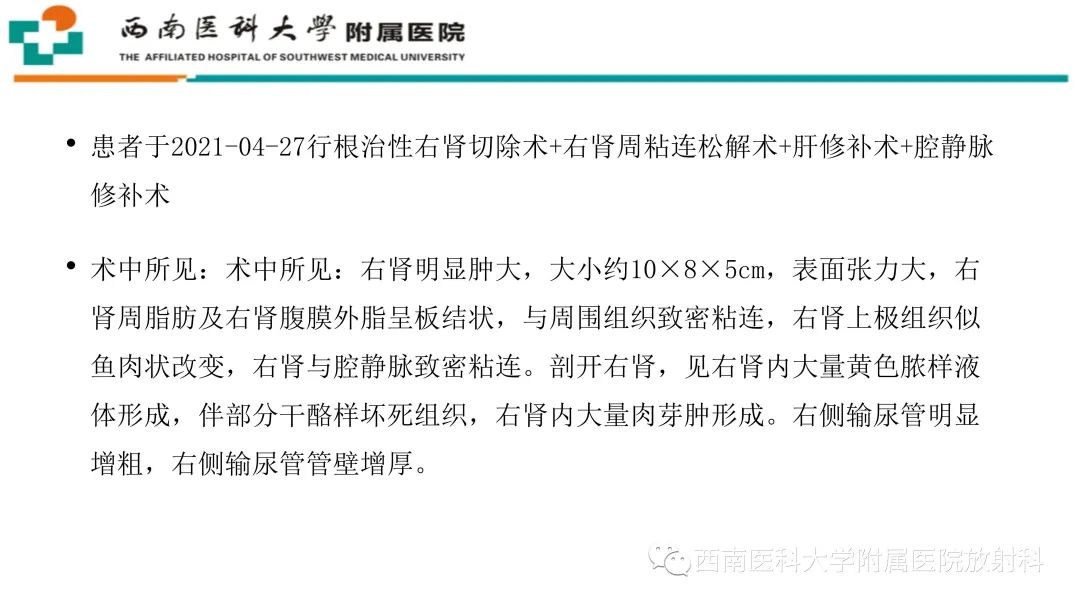影像PPT - 【PPT】黄色肉芽肿性肾盂肾炎-10
