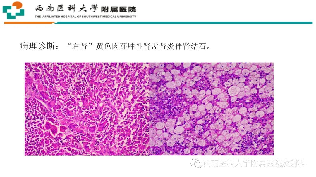 影像PPT - 【PPT】黄色肉芽肿性肾盂肾炎-11