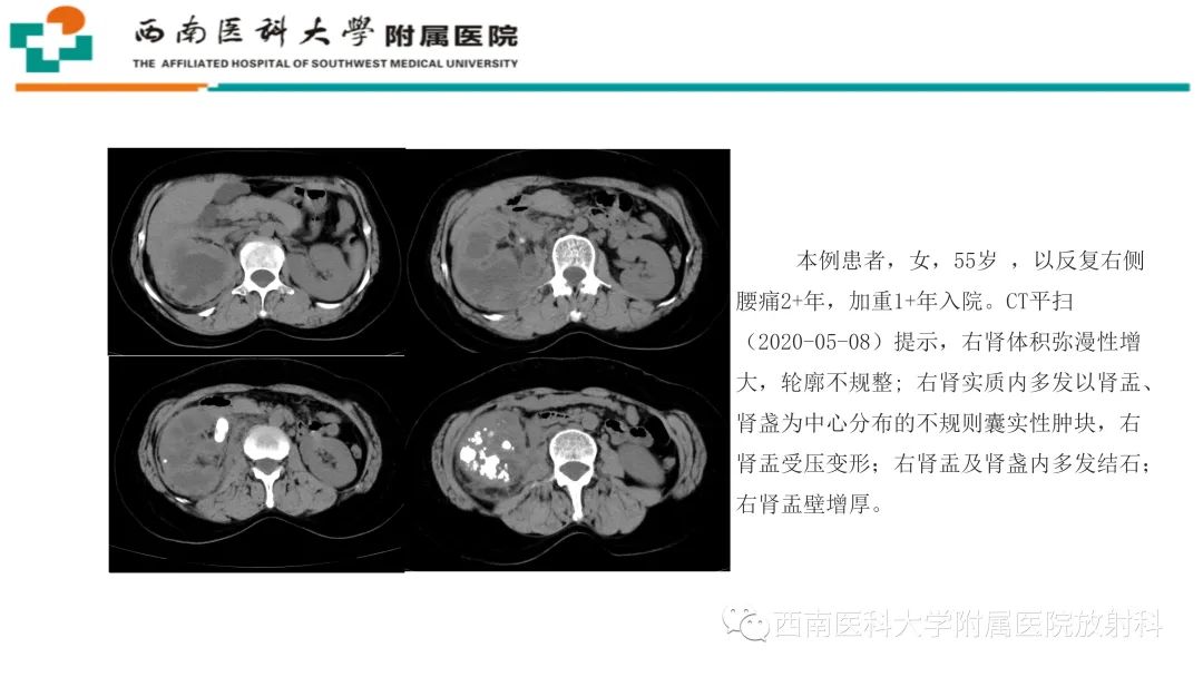 影像PPT - 【PPT】黄色肉芽肿性肾盂肾炎-20