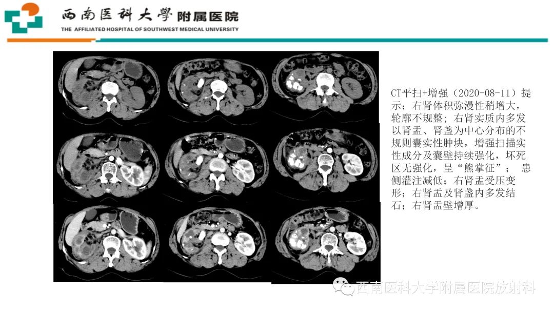 影像PPT - 【PPT】黄色肉芽肿性肾盂肾炎-21
