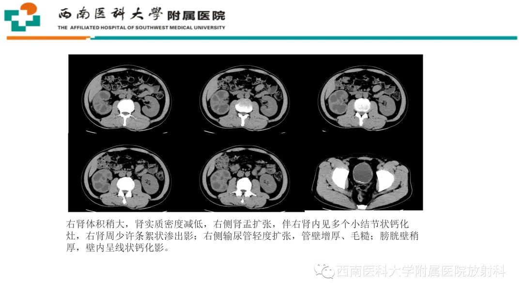 影像PPT - 【PPT】黄色肉芽肿性肾盂肾炎-24