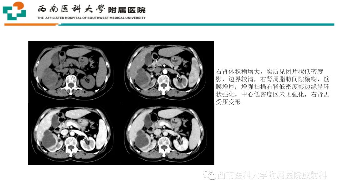 影像PPT - 【PPT】黄色肉芽肿性肾盂肾炎-26