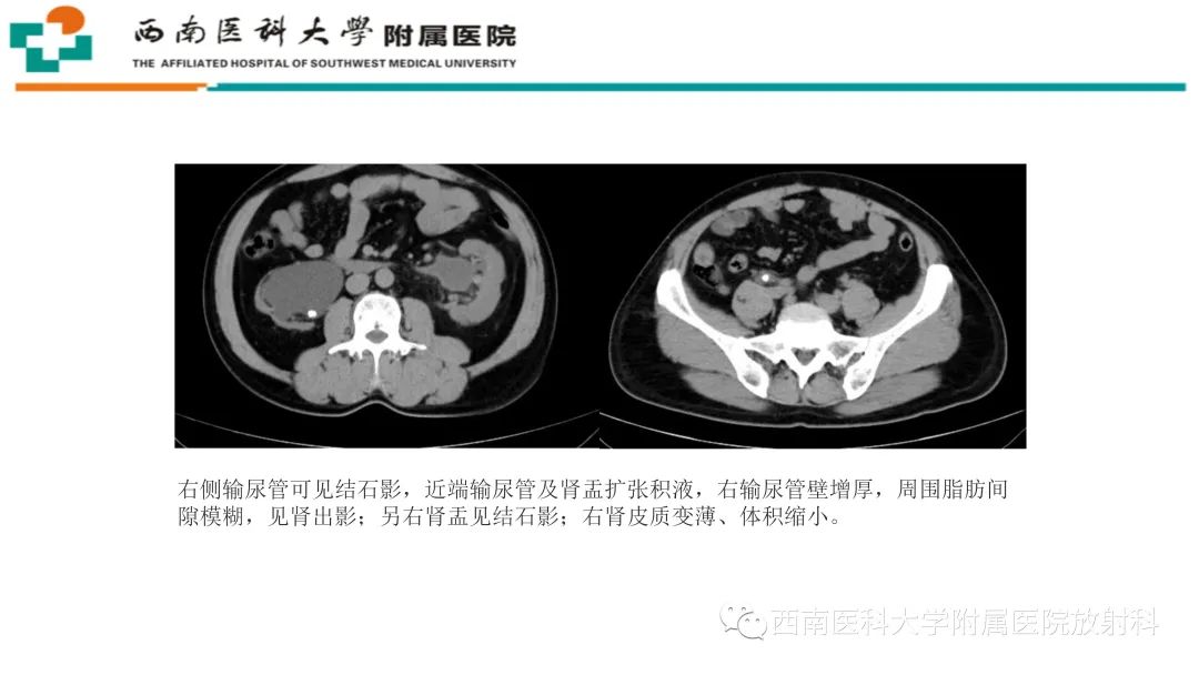 影像PPT - 【PPT】黄色肉芽肿性肾盂肾炎-28