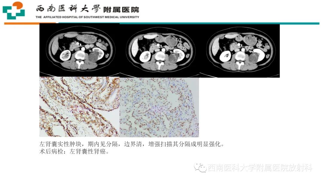 影像PPT - 【PPT】黄色肉芽肿性肾盂肾炎-30