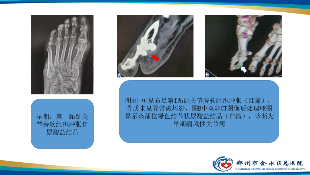 影像PPT - 【PPT】痛风的影像诊断及鉴别诊断-10