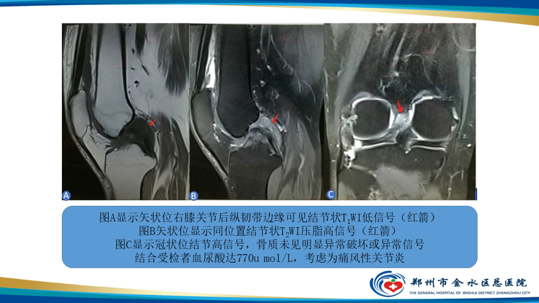 影像PPT - 【PPT】痛风的影像诊断及鉴别诊断-11