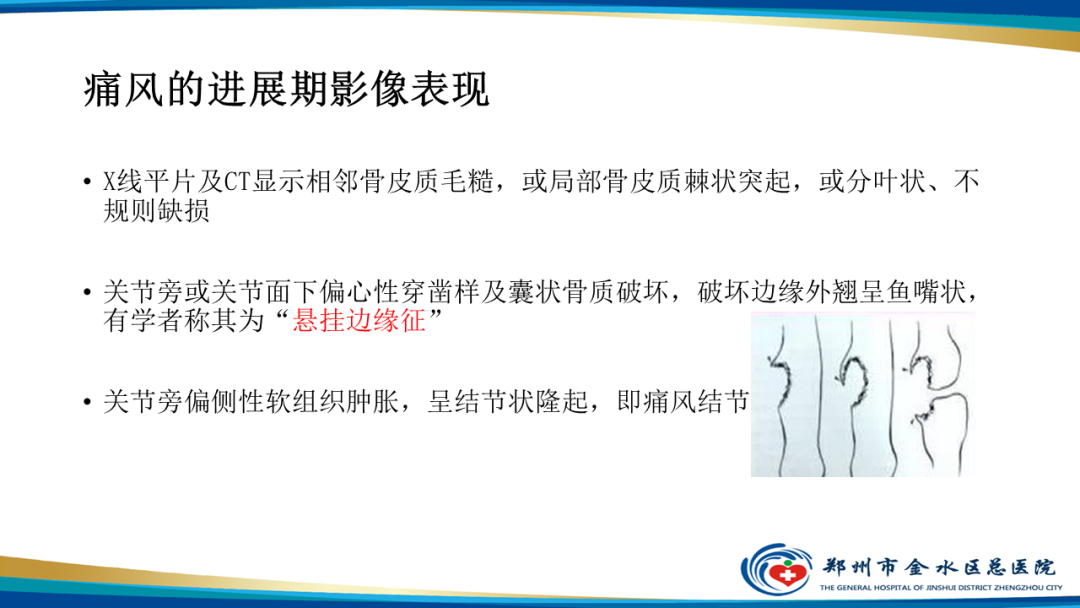 影像PPT - 【PPT】痛风的影像诊断及鉴别诊断-12