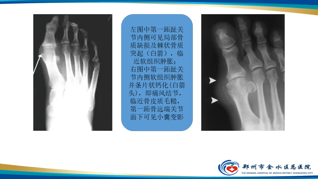 影像PPT - 【PPT】痛风的影像诊断及鉴别诊断-14