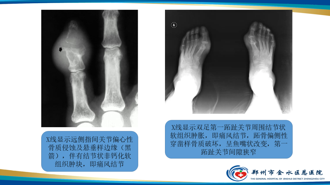 影像PPT - 【PPT】痛风的影像诊断及鉴别诊断-15