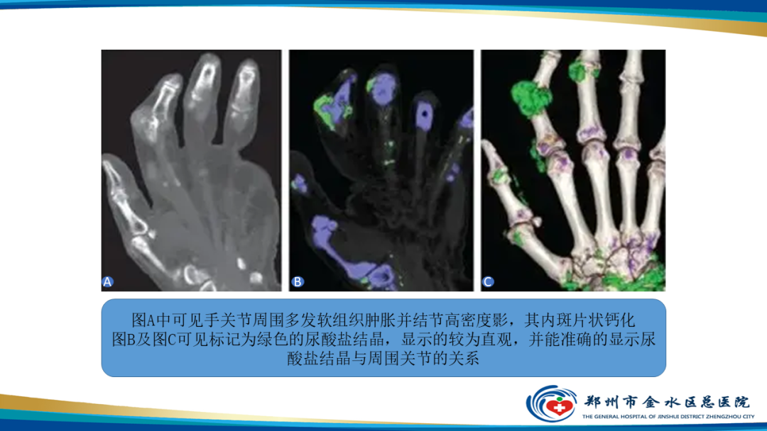 影像PPT - 【PPT】痛风的影像诊断及鉴别诊断-16