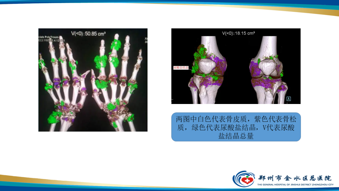 影像PPT - 【PPT】痛风的影像诊断及鉴别诊断-17