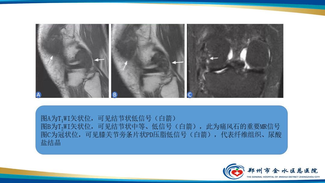 影像PPT - 【PPT】痛风的影像诊断及鉴别诊断-19